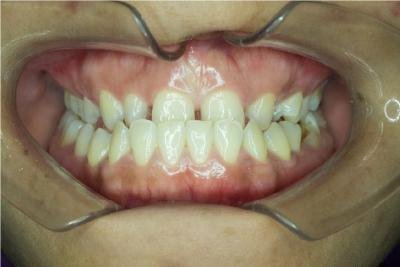 How to Correct a Crossbite Without Braces