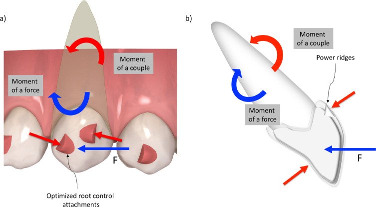 Biomechanics of Clear Aligners: How Force Drives Precision in Tooth Movement