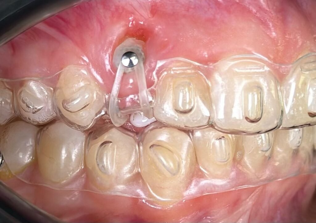 Impacted Canines & Clear Aligners: A Modern Workflow from CBCT to Surgical Precision