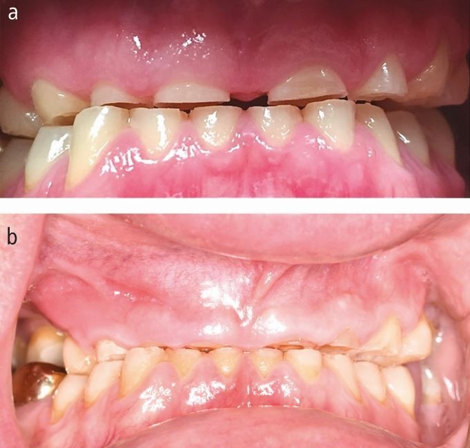 Clear Aligners for Bruxism Patients